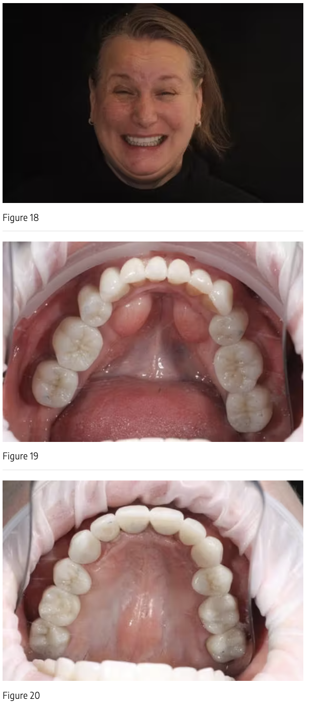 Thay đổi toàn diện nụ cười: Tinh hoa của phục hình răng toàn hàm